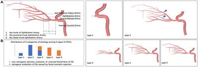 Morphological and functional abnormalities of ophthalmic artery in patients with ophthalmic vascular accidents